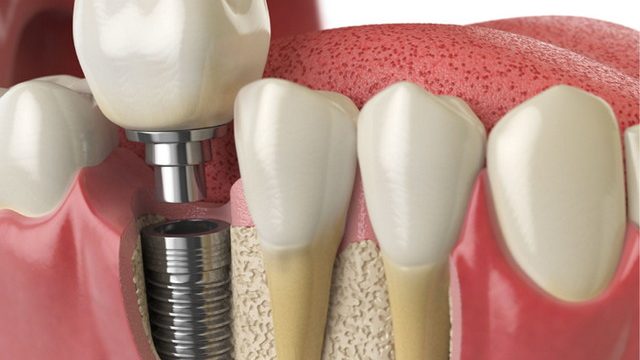 Dental Implants