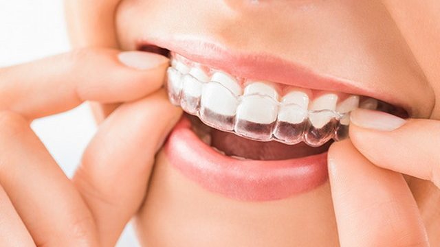 Sports Guards & Night Guards