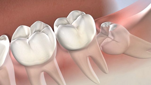 Wisdom Teeth Removal